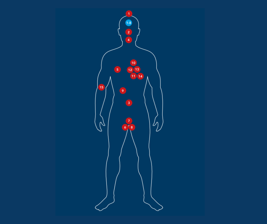 Outline of a body with numbers 1-15 on it to illustrate areas of the body that experience side effects